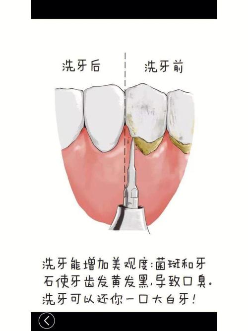 洗牙的过程是怎样的？洗牙后有哪些需要注意的「男子洗牙查出白血病视频」 啤酒